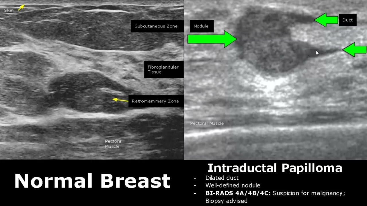 Breast Cancer Malignant Ultrasound Images