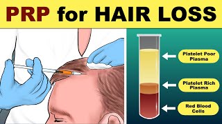 PRP Hair Treatment | prp hair loss treatment before and after | Hair loss Treatm