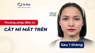 Khôi Phục Nếp Mí Đều Và Tự Nhiên Sau 1 Tháng Cắt Mí Tại Dr. Eye!