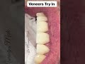 Veneers Try In