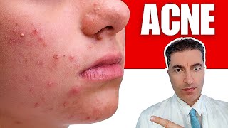 How to Cure Acne Naturally?