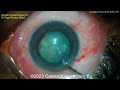 cataractcoach™ 2026 using phaco vacuum to lift the nucleus