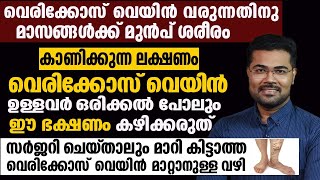 വെരിക്കോസ് വെയിൻ ഉള്ളവർ ഒരിക്കൽ പോലും ഈ ഭക്ഷണം കഴിക്കരുത് Varicose vine| health tip malayalam