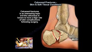 Calcaneal Fractures Skin \u0026 Soft Tissue Condition - Everything You Need To Know - Dr. Nabil Ebraheim