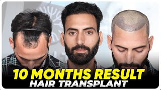 Hair Transplant in Davanagere | Best Results \u0026 Cost of Hair Transplant in Davanagere