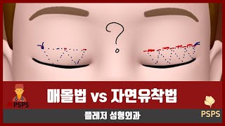 자연유착법의 진실 & 비절개 쌍꺼풀 수술이 성공하려면? (by 성형외과 전문의)