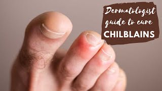 Chilblains or Perniosis I Dr Surbhi, MD