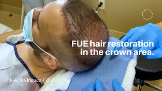 FUE hair restoration in the crown area.