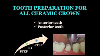 TOOTH PREPARATION FOR ALL CERAMIC CROWN / CROWN & BRIDGE / FPD