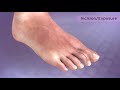 HammerTube Hammertoe System