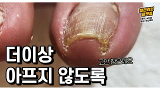 아픈데 계속 건드리는 내성발톱 관리에 진이 빠지다  (ingrown toenail / 대구레푸스삼덕점, 레푸스진천역점)