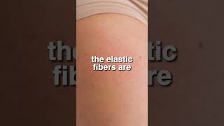 What Causes STRETCH MARKS?