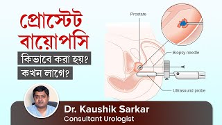 প্রোস্টেট বায়োপসি কখন লাগে, কিভাবে করা হয়? How Prostate Biopsy is Done? Why Biopsy is needed