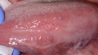 What Are The Early Signs Of Mouth Cancer