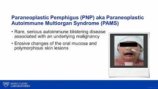 Immunobullous Diseases: Paraneoplastic Pemphigus (PNP)ht 2019 04 08 paraeoplatic pemphigus