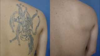 タトゥー除去レーザー経過報告1年8ヵ月　 Laser Tattoo Removal, Interim Report (20 Month)