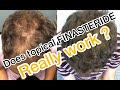 Man uses topical Finasteride and Minoxiidil to regrow hair.