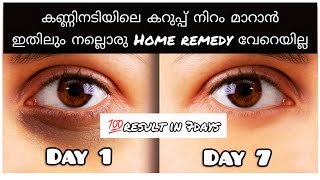 കണ്ണിനടിയിലെ കറുപ്പ് മാറാൻ ഇനി 7 ദിവസം മതി|get rid of dark circles at home|j2 world