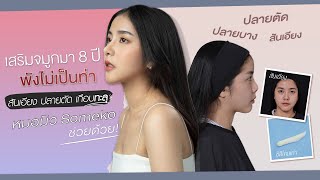 รีวิวเสริมจมูกพลาด8ปีที่พังปลายทู่ปลายบางสันสูงต้องแก้กับหมอมิวsomeko l