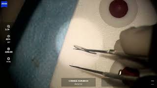 Artificial Iris (Human Optics) implant (Traumatic corneal laceration \u0026 iris loss \u0026 cataract)