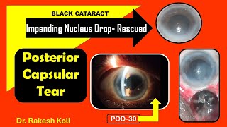 SICS // Impending Nucleus drop Rescued //Black catarct // PC Rent // RIMS ,Rcr // Dr.Rakesh Koli .