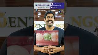 பல் அடைத்த பின் மீண்டும் சொத்தை வருமா? - Cavity Under Filling | Denta Kings