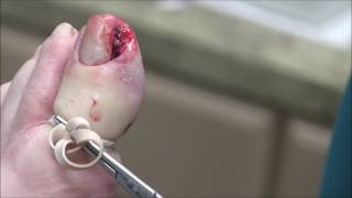 Infected Ingrown Toenail Removal With Pyogenic Granuloma