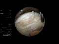 graftnet™ tissue collector and biocartilage® extracellular matrix for cartilage lesions in the hip