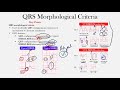 ekg morphological criteria for ventricular tachycardia the ekg guy www.ekg.md