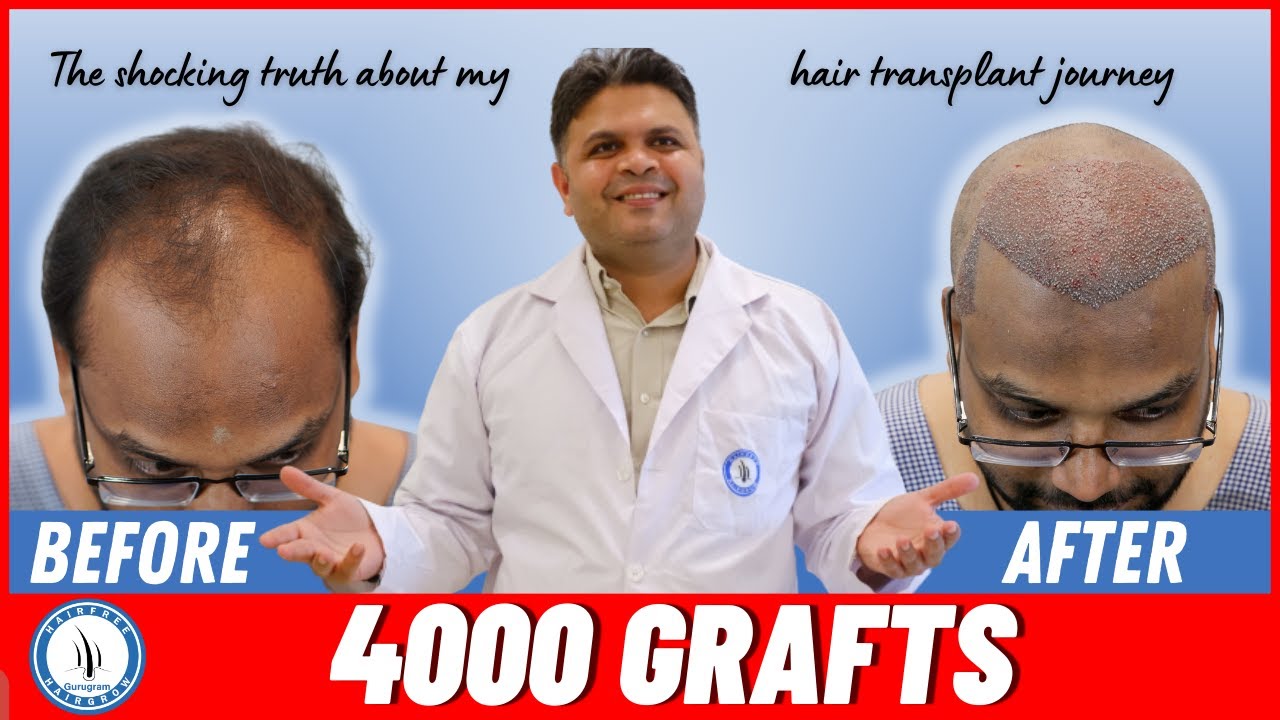 My Life-Changing Hair Transplant Journey At India’s Best Hair ...