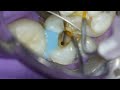 Molar Root Canal Procedure Technique w/ Gentle Wave