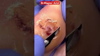 DEBRIDING A TOE ULCER🦶🏻#shorts