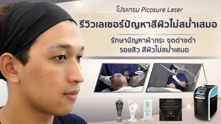 🚩รีวิวโปรแกรม Picosure Laser รักษาฝ้ากระ สีผิวไม่สม่ำเสมอ