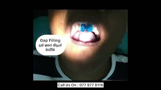 GAP FILLING ( Median diastema  closure )දත් අතර ඇති හිදැස් පිරවීම