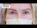 eyebrow transplants restore brows with real hair