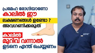 കാൽ പാദത്തിൽ ഈ ലക്ഷണങ്ങൾ ഉണ്ടോ ? അവഗണിക്കരുത് | Diabetic Foot Malayalam | Dr. Vineeth Kumar