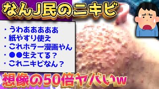 【2ch閲覧注意スレ】なんJ民ってニキビ悩んでる？←猛者が降臨するww【ゆっくり解説】