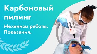 Карбоновый пилинг на неодимовом лазере