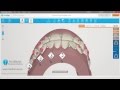 Invisalign ClinCheck Pro Tutorial: contatos oclusales - Ortodoncia Friedländer Barcelona