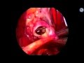 Minimally invasive aortic valve replacement using the Perceval S sutureless valve