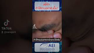 ขยี้ตาแรงๆอาจทำให้ตาบอดได้!!! สุขภาพดีกับหมอธีระเทพ Dr.A​channel​