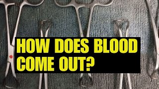 Clots and blood removal in embalming