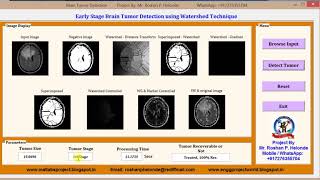 Matlab code for Early Brain Tumor Detection and Classification using Watershed Technique