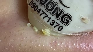 Acne Treatment Huong Da Nang# _ 2024   #blackheads 710