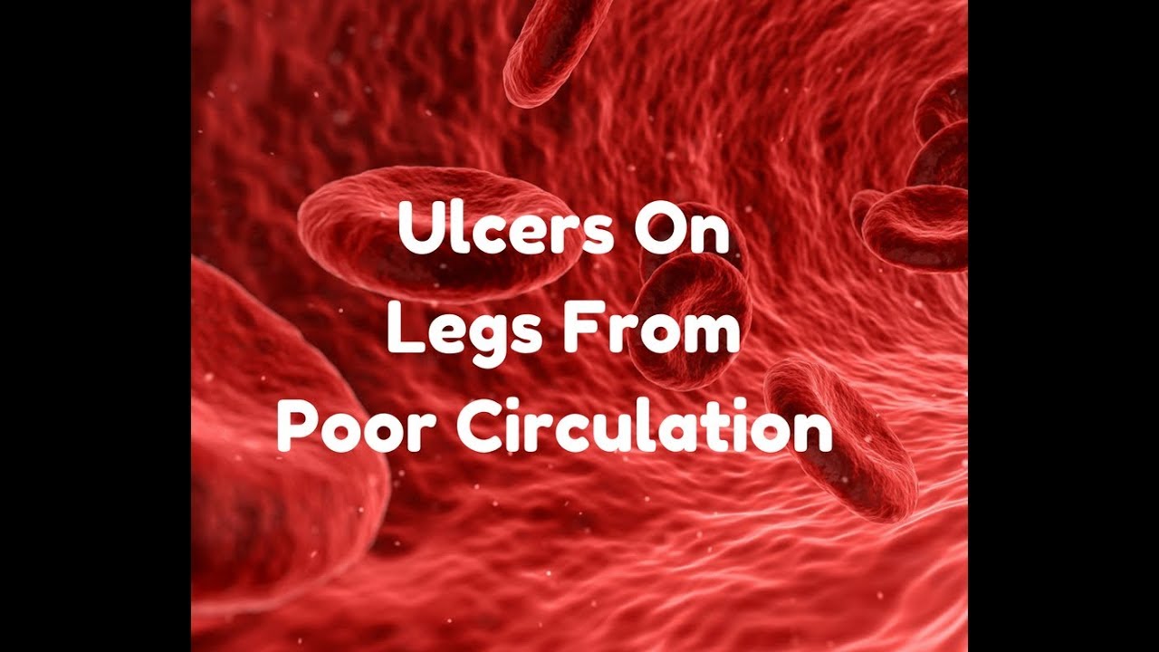 Leg Ulcers From Poor Circulation