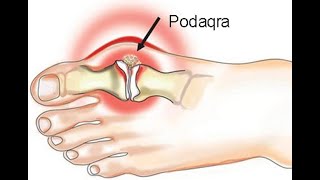 Revmatoloq Həsənağa Qəmbərov PODAQRA xəstəliyi haqqında danışır