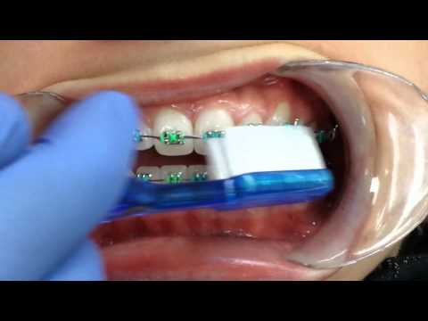 Toothbrushing upper teeth with braces Toothbrushing upper teeth with braces