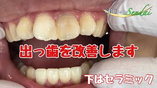 前歯４本をセラミックで綺麗に（術前→仮歯→ジルコニアセラミック）