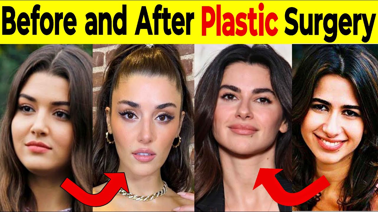 Turkish Actors Before And After Surgery Plastic Surgery Turkish