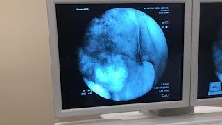 Intra-Articular Injection of the Sacroiliac Joint Under Fluoroscopic Guidance